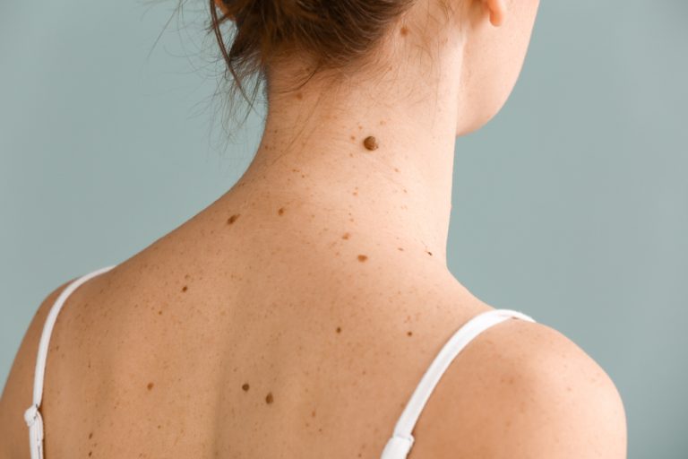 Grains de beauté Fil santé jeunes