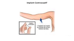 L'implant contraceptif | Fil santé jeunes