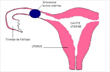 La grossesse extra-utérine Fil santé jeunes